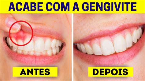 Gengiva Inflamada Tratamento Caseiro - Acabe Com a GENGIVITE Com 4 Excelentes Remédios CASEIROS ! - YouTube