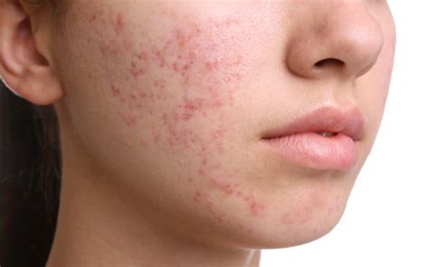 Effective Hormonal Acne Treatment: Tips and Solutions for Clearer Skin