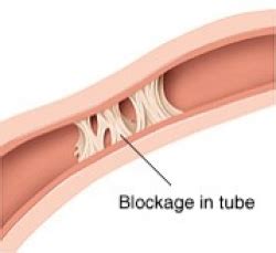 Fallopian Tube Recanalization | Stanford Health Care