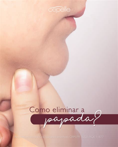 Papada Inchada Do Nada - Como eliminar a papada? - Cepelle Dermatologia | Curitiba