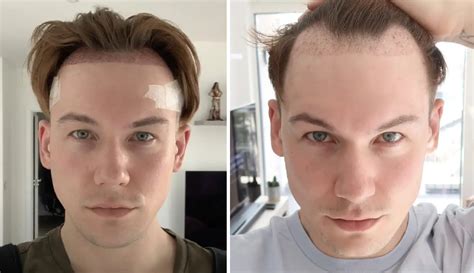 hair transplant years    recession years   hair