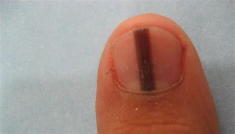 Linha Preta Na Unha Câncer - O que significa uma linha preta na unha? – Fatos Desconhecidos
