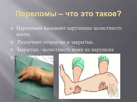 ПЕРЕЛОМЫ Переломы Переломы что это такое