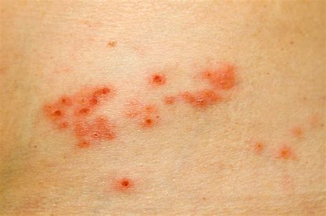 shingles rash shingles dr bruce robinson