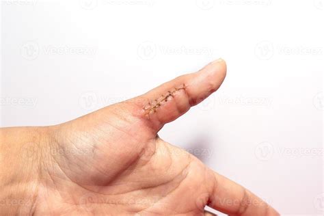 close    hand wound  stitches thumb wound  white background