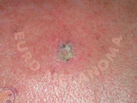 Видове рак на кожата - Euromelanoma