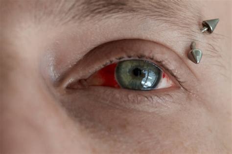 Bulging Cornea Stock Photos, Pictures & Royalty-Free Images - iStock