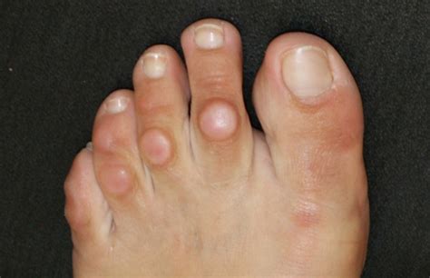 Мозоль - причины и лечение | Kosmetologiya-dermatologiya.az