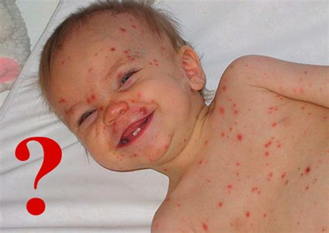 Герпес 6 типа: симптомы и лечение вируса герпеса 6 типа у детей и взрослых