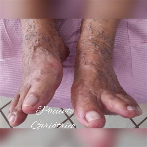 Paciente Geriátrica, presenta heloma... - Podología La Paz