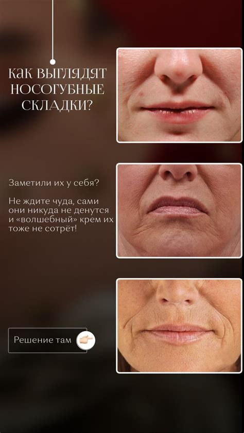 Носогубные складки | Косметология, Ботокс губы, Инъекции губ