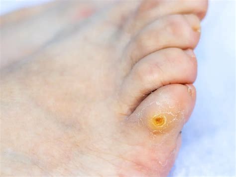 occhio  pernice podologo turconi