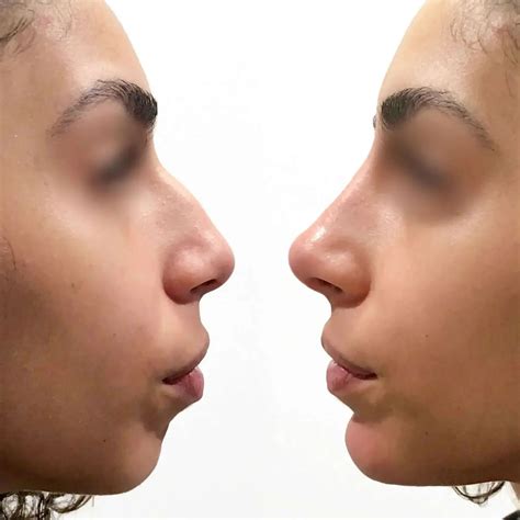 NoseFix: Filler