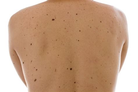 Удаление родинки: показания, методы, советы врача | MedAboutMe