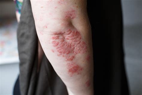 Psoriasis : causes, symptômes et traitements - Conseils santé