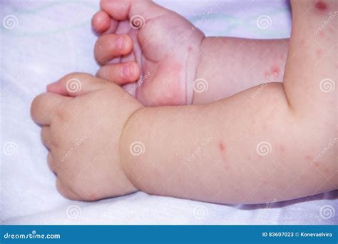 Eczema On Legs Baby