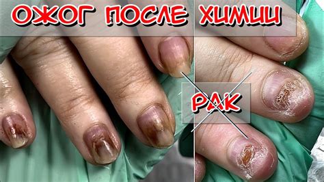 Ожог ногтей после химиотерапии / Ногти после рака / Ногти после химии ...