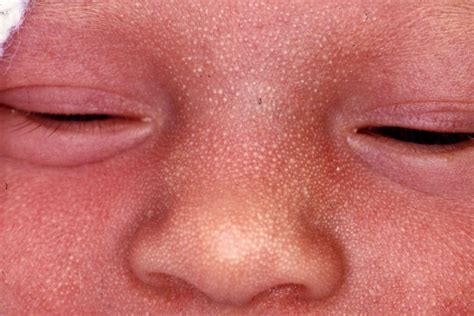 newborn rash common rashes   theyre severe
