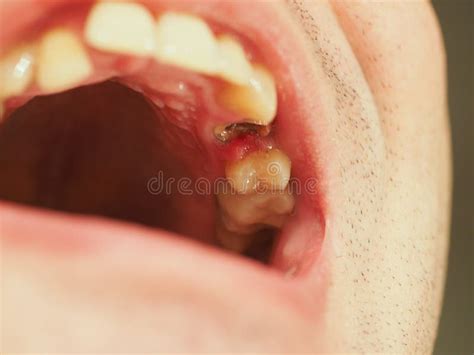 how to remove a broken tooth root at home