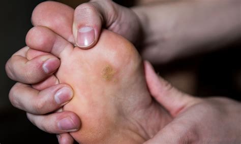 safely remove  foot corn  home premier podiatry