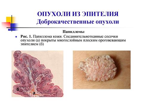 Опухоли. Опухолевый процесс - презентация онлайн