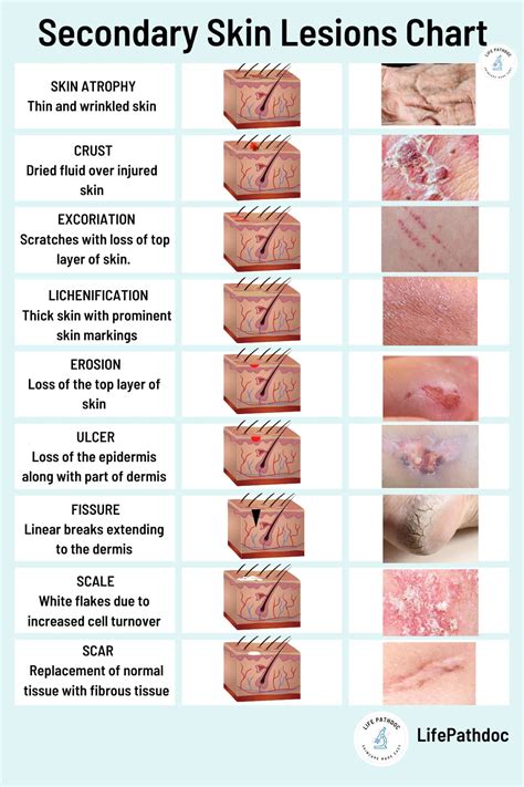 Skin Lesions: Types with Chart, Pictures, Causes, Treatment