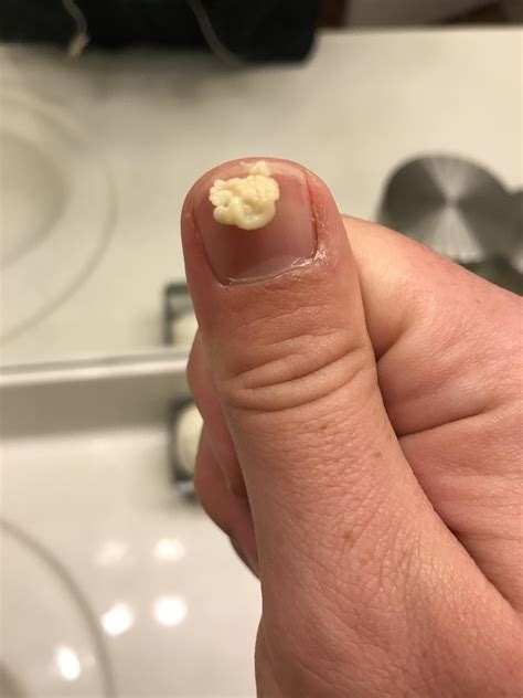 Popcorn Hull Stuck In Tonsil at John Heidt blog