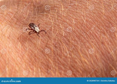 Tick on Human Skin Bites and Carries Disease Stock Photo - Image of ...