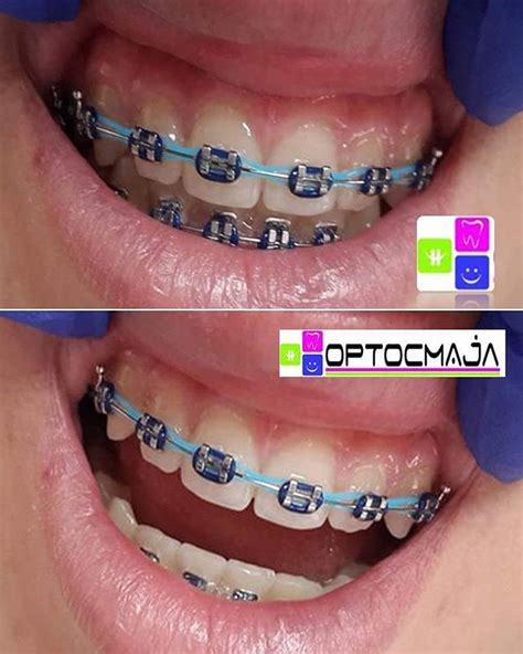 10 colored blue braces for adults and kids | Braces Explained