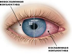 Конъюнктивит : причины, симптомы, лечение конъюнктивита