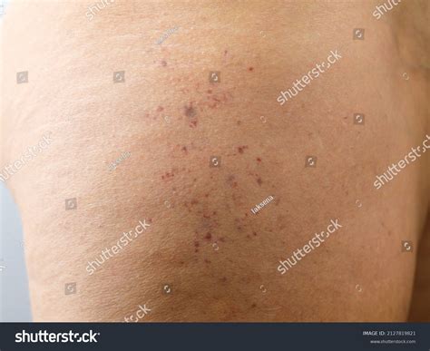 groups red spots petechiae  thigh shutterstock