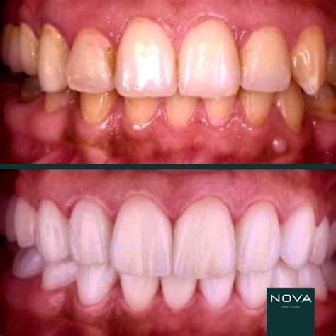 colour corrector serum teeth whitening nova south africa