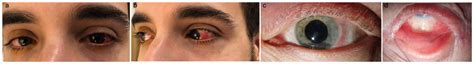 Shield Cataract Atopic Dermatitis