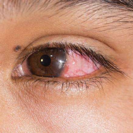 eye infection recognizing symptoms  comprehensive guide