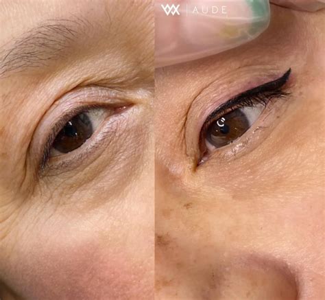 Eyeliner Tattoo Removal: Overcoming The Pain and Struggles