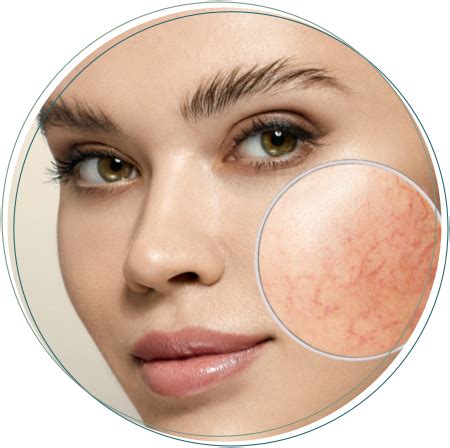 rosacea georgia skin specialists