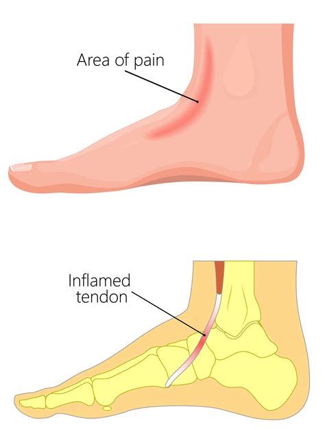 7 Powerful Ways to Treat Tibialis Anterior Tendonitis