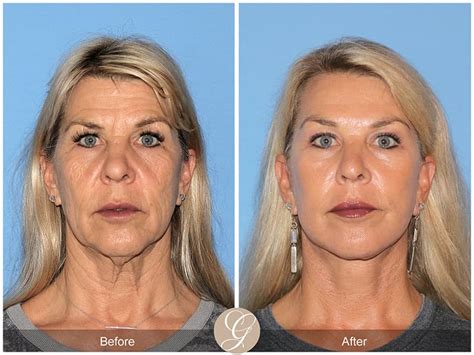 Before & After Face Procedures in Newport Beach CA | Orange County ...