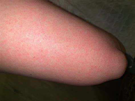 I Got Dengue Fever In French Polynesia, & This Is What It Was Like