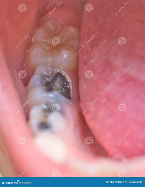 Tooth Caries Royalty-Free Stock Photo | CartoonDealer.com #107721327