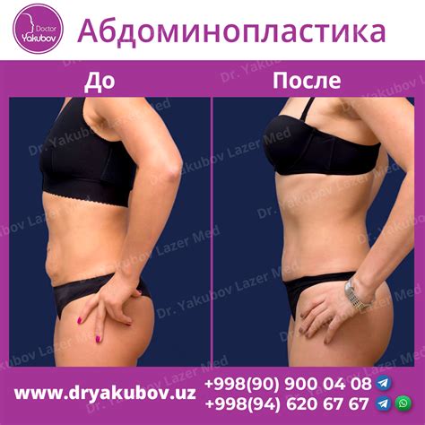 Абдоминопластика Фото До И После Цена — Картинки фотографии