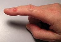 red nodule   finger medicine today