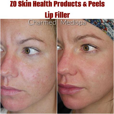 Acne Management With ZO Skin Health and 3 Step Peels – Charmed Medispa
