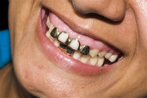 Permanent Open Face Gold Crown Tooth - Design Talk
