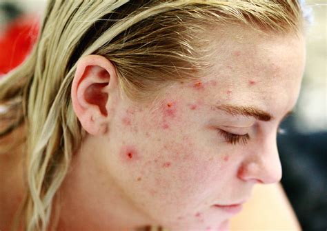 Blackheads Vs Whiteheads: Differences, Treatment, and More