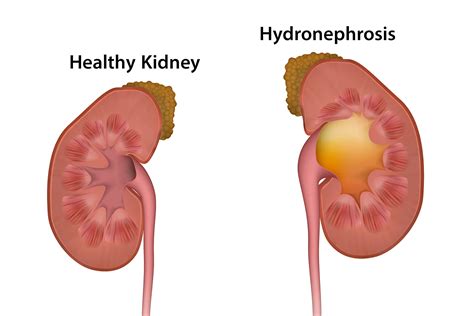 mild hydronephrosis ultrasound