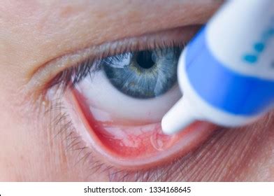 Female Eye Conjunctival Sac Instill Eye Stock Photo (Edit Now) 1334168669
