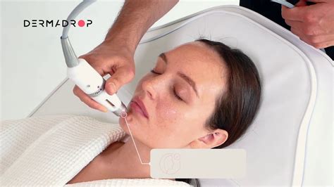 Мезотерапия без инъекций - Dermadrop (Дермадроп) - YouTube