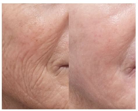 laser resurfacing   gallery northside dermatology