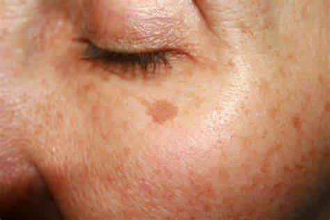 Why You Get Sun Spots on Your Face & How to Treat Them | Glamour UK